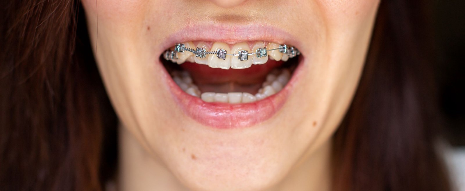 Braces and Aligners
