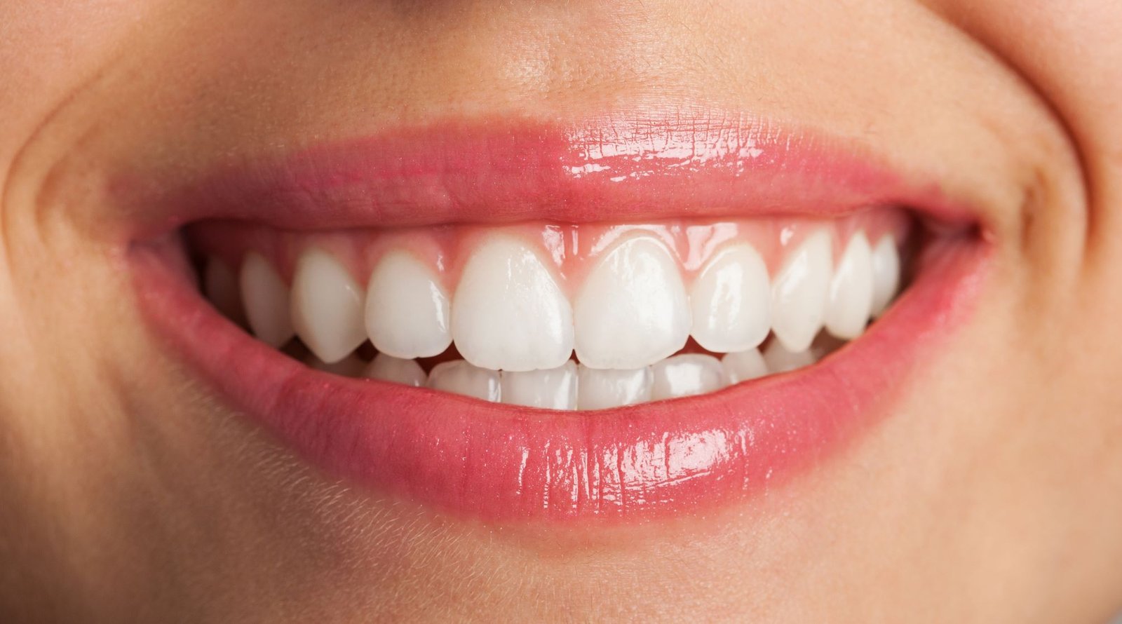 Veneers